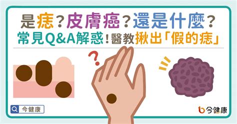 痣為什麼會凸起來|是痣？皮膚癌？還是什麼？常見Q&A解惑！醫教揪出「。